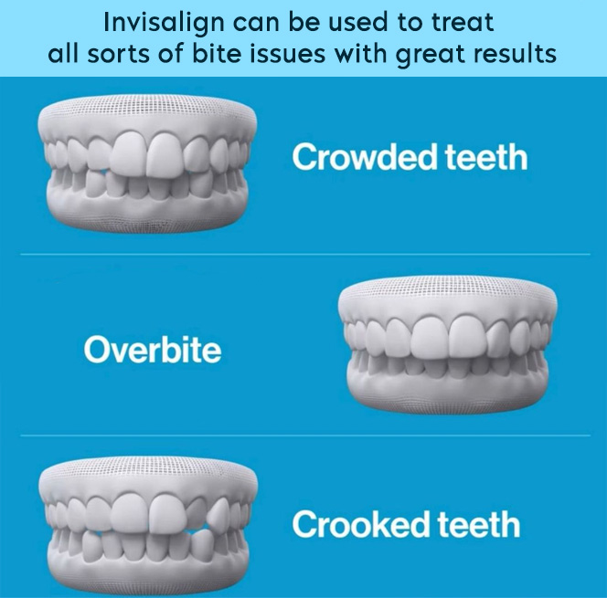 Invisalign can be used to treat all sorts of bite issues with great results