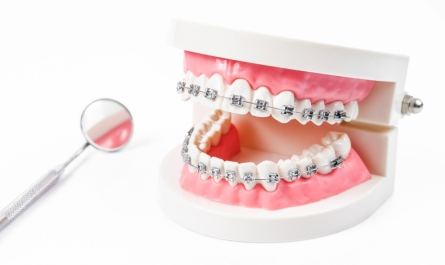 Advantages and Cost of Traditional Metal Braces -