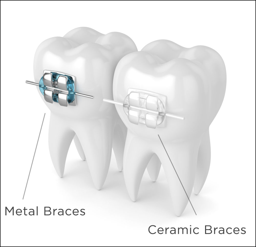 Ceramic Braces: Advantages and Cost - Lotus Dental Care clinic