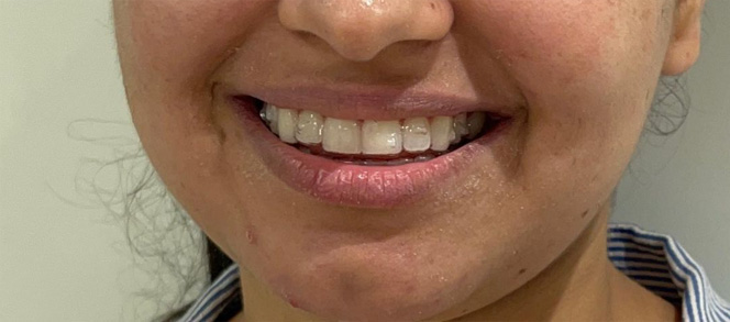 girl with Invisalign 