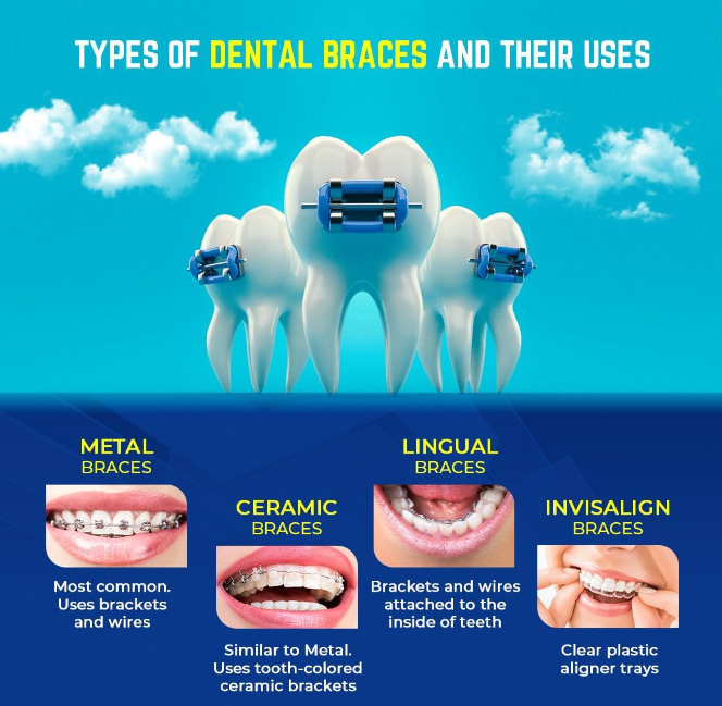 types of dental braces and use