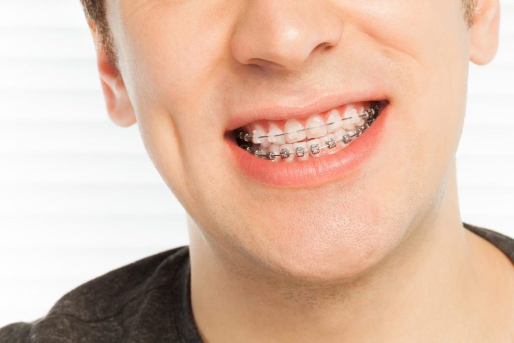 Advantages and Cost of Traditional Metal Braces