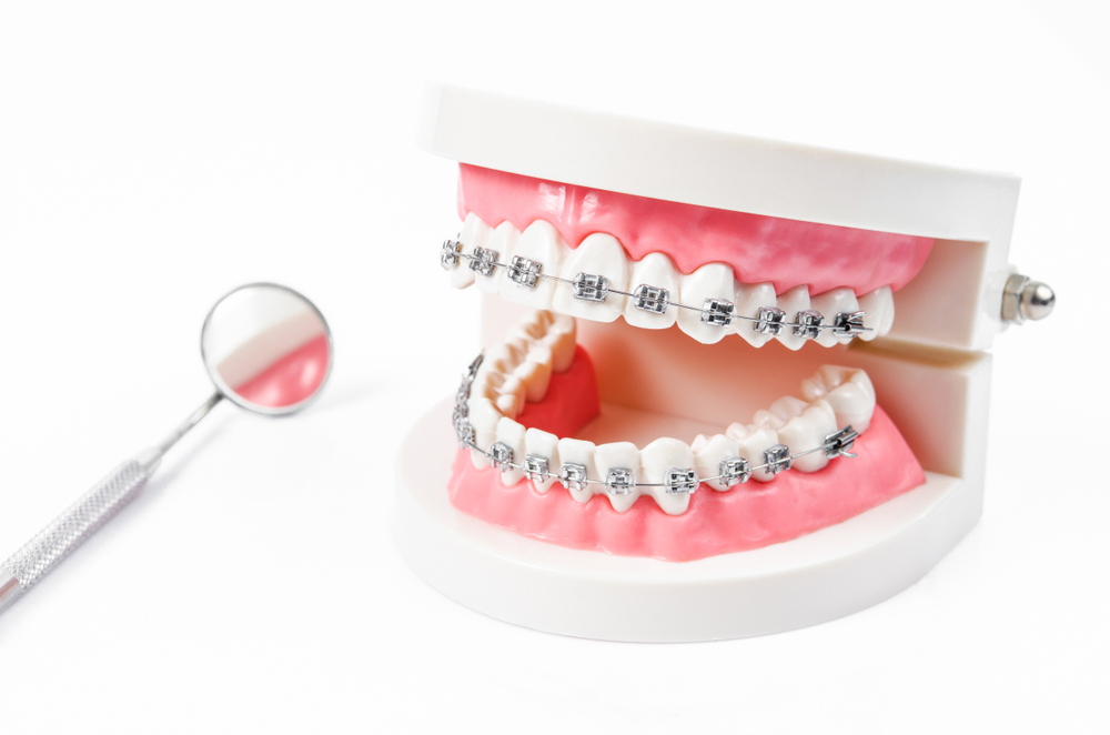 Advantages and Cost of Traditional Metal Braces